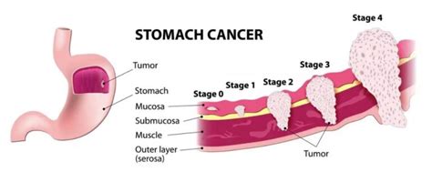 Stomach Cancer Symptoms And Causes Aarogayadham Hospital