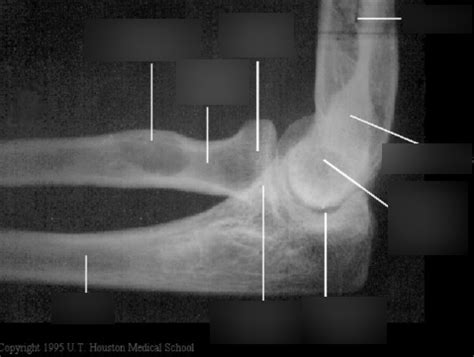 Radius and Ulna Diagram | Quizlet