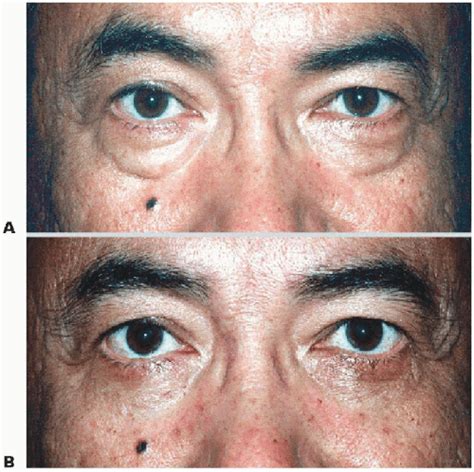 Fat Repositioning In Transconjunctival Lower Eyelid Blepharoplasty