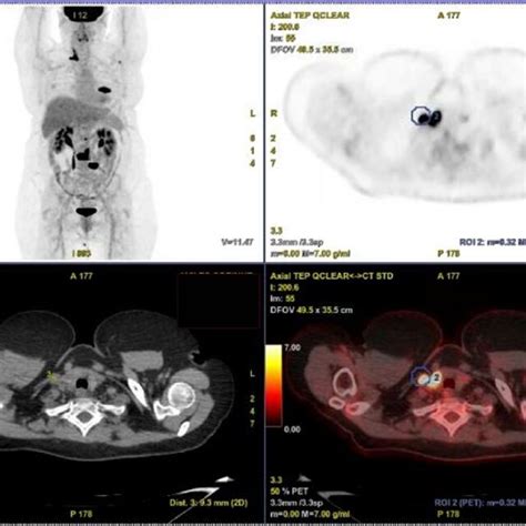 18 F FDG PET CT Scanner Intense Hypermetabolic Focus SUV Max 16 3