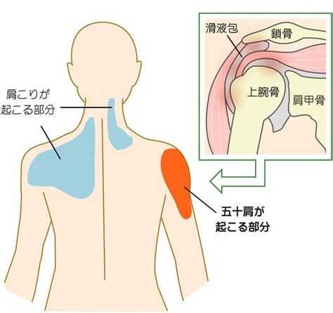 四十肩・五十肩（肩関節周囲炎） 巣鴨整体院 Mikata