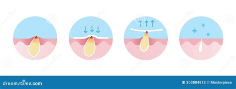 Step Of Blackhead Removal Vector Icon Set Illustration Isolated On