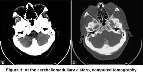 Figure 1 From Calcifying Pseudoneoplasm Of The Cerebellomedullary