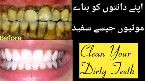 دانت بناے مضبوط اور موتیوں جیسے چمک دار Diy Teeth Whitening At Home