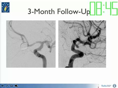 Neuroform Atlas支架治疗颅内动脉瘤