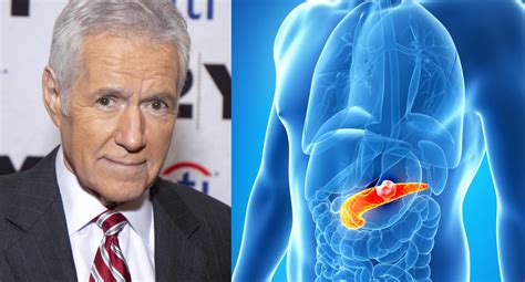 Alex Trebek pancreatic cancer symptoms survival rates