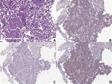 High Power View Of The Tumoral Cells In The Fine Needle Biopsy Taken