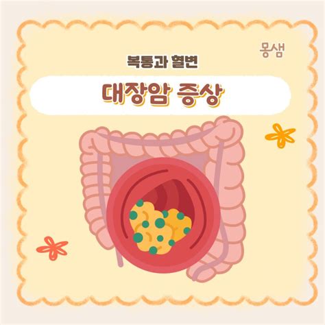 대장암 초기 증상 1기 2기 3기 4기 말기 증상 차이와 치료 네이버 블로그