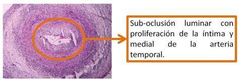 2 Biopsia Arteritis Temporal Celulas Gigantes Ocronos Editorial