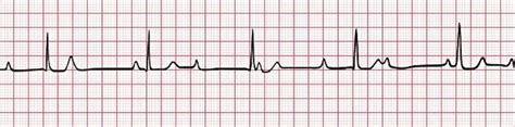 Heart blocks: first, second and third degree | Deranged Physiology