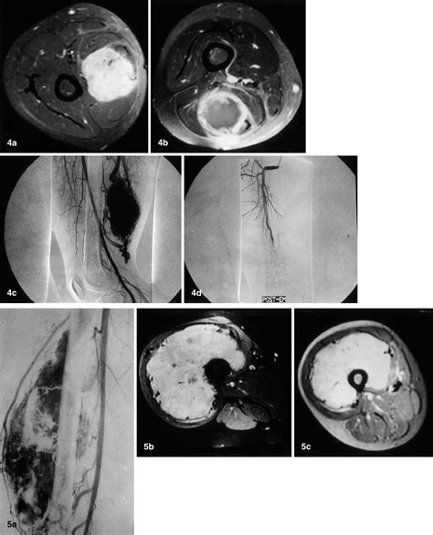 a–c Alveolar soft part sarcoma initially considered as an arteriovenous ...