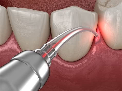 Lanap Laser Treatment Arkansas Periodontal And Implant Associates