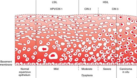 Intraepithelial Neoplasia Of The Lower Genital Tract Cervix Vagina Vulva Etiology