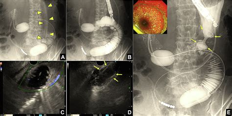 Long Term Outcomes Of Eus Guided Balloon Occluded Gastrojejunostomy