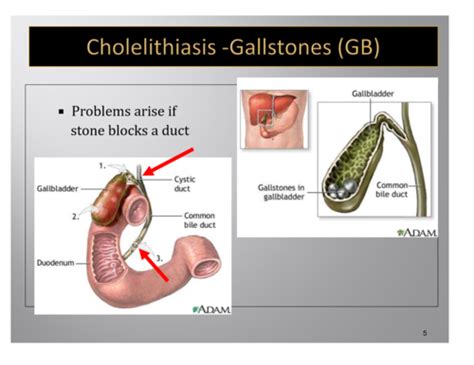 Med Surg Cholelithiasis Vs Cholecystitis Flashcards Quizlet