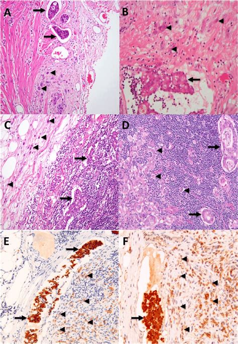 Hematoxylin And Eosinstained Section Of Primary Gastric Carcinoma A