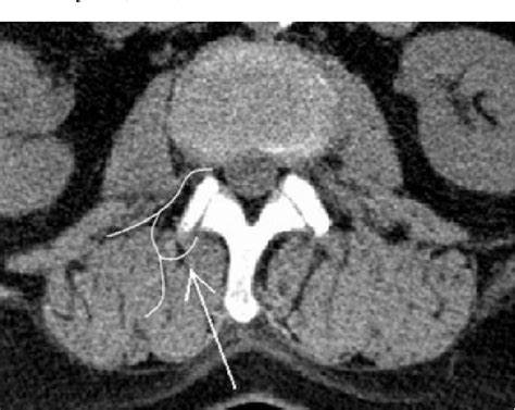 Figure 1 From Radiofrequency Denervation Of The Facet Joints In Chronic