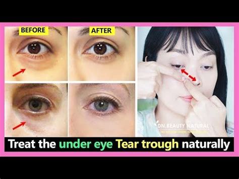 How To Treat The Under Eye Tear Trough Get Rid Of Tear Troughs In