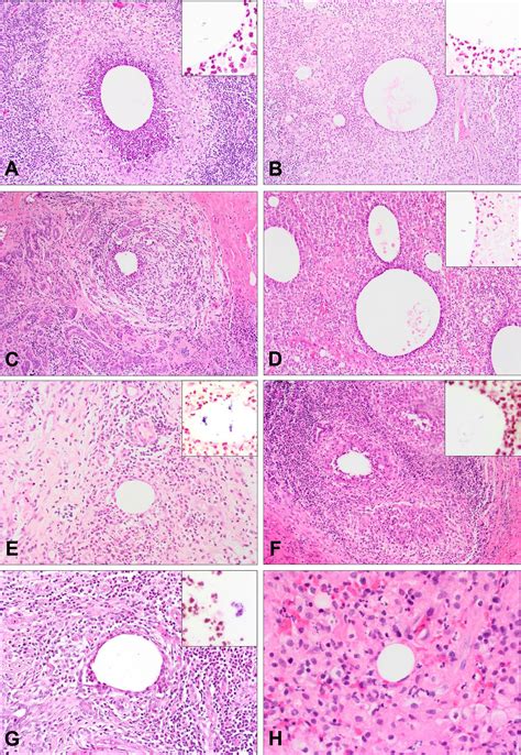 Cystic Neutrophilic Granulomatous Mastitis Associated With