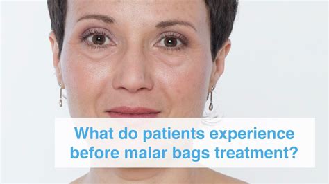 What Do Patients Experience Before Malar Bags Treatment Youtube