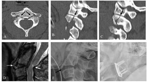 Proposal Of Treatment Strategy For Pedicle Fractures Of The C2 An