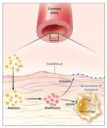 Inflammation Atherosclerosis And Coronary Artery Disease NEJM