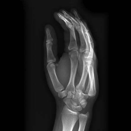 Wrist Radiograph An Approach Radiology Reference Article