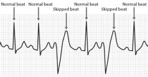 How Does Stress Cause a “Skipped” Heartbeat? » Scary Symptoms