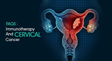 FAQs Immunotherapy And Cervical Cancer Canceronco