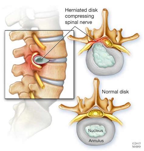 Essentials Of A Disc Herniation Bulging Discs Physiotherapists In