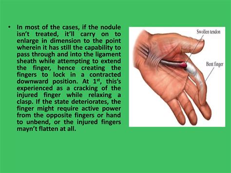 What Is Trigger Finger And What Are Its Symptoms Ppt