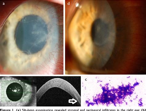 Figure 1 From Acanthamoeba Keratitis Associated With Scleral Contact Lens Use In A Keratoconus