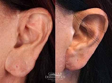 Earlobe Repair Appearance Function Contour Dermatology