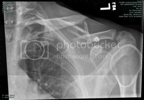 Broken collar bone, no surgery???- Mtbr.com