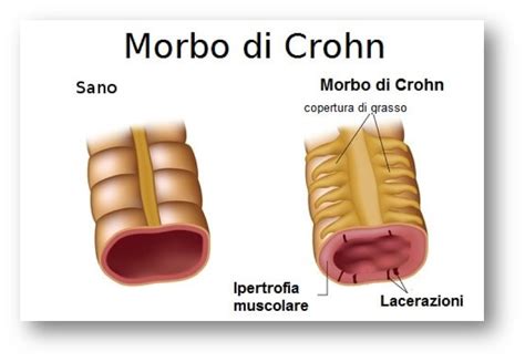 Morbo di Crohn cos è quali sono i sintomi e come si cura