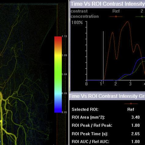 A Color Coded Map Of Pretreatment Angiography Three Regions Of