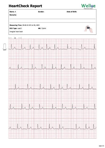 What AF looks like on an ECG - Atrial Fibrillati...