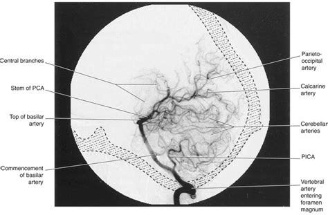 Stroke Vascular Territories And Individual Variabilities In