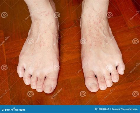 Skin Rashes On Feet