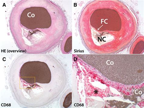 Blood Clot. Plaque Rupture And Blood Clot Formation, Heart Muscle ...