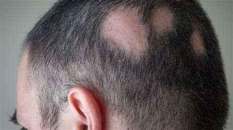 Fda Approves Eli Lilly S Olumiant Drug For Severe Alopecia Areata