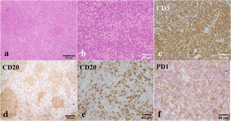 Pattern C Immunoarchitecture In One Of The Cases A And B The H E Slide