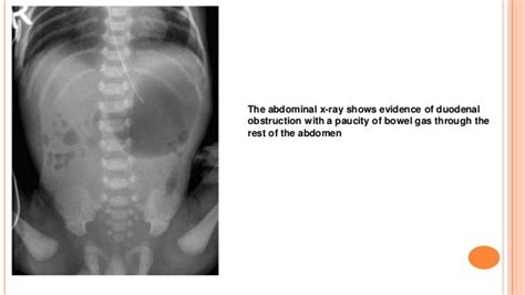 Acute abdomen in children