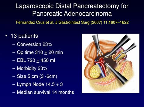 PPT Laparoscopic Pancreatectomy PowerPoint Presentation ID 447449