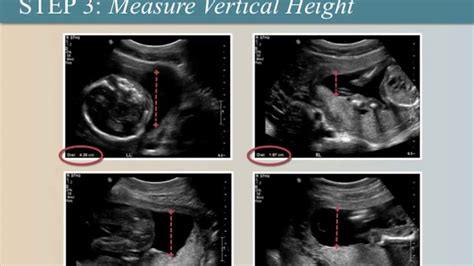 How To Measure Amniotic Fluid Properly On Ultrasound Youtube