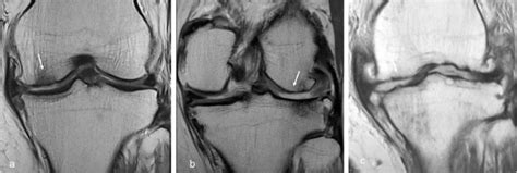 Coronal PD weighted MRI images depicting various patterns of chondral ...