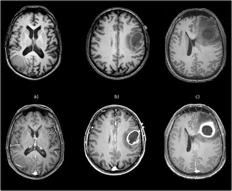 3d Ax T1 Mri