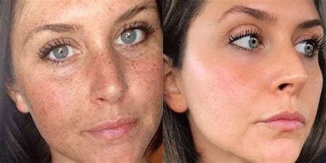 This Womans Before And After Sun Damage Photo Is Going Viral