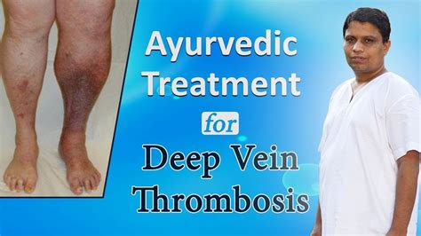 Ayurvedic Treatment For Deep Vein Thrombosis Acharya Balkrishna Youtube