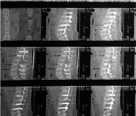 Figure From Short Segment Versus Long Segment Pedicle Screws Fixation